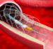 A Milestone in Cardiology: Abbott’s Coronary Stent Arrival in India